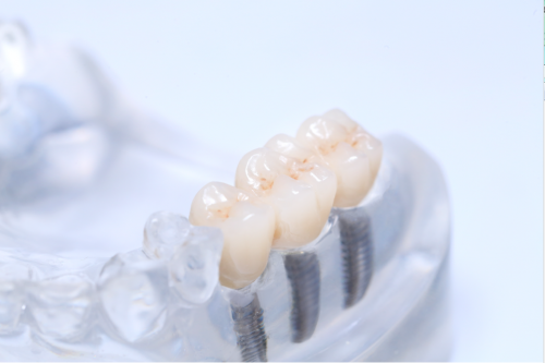 Full Contour Zirconia