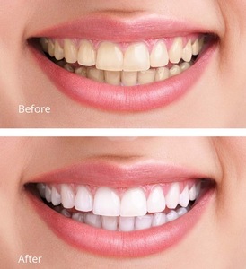 Carbamide Peroxide Teeth Whitening syringe Gel - 22% , 35%, 44% + non-Peroxide gel