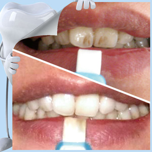 New invention home 2019 patent non peroxide smile strips teeth whitening