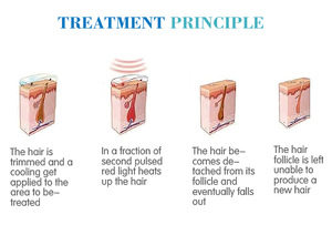 12 hours non-stop continue working comfortable laser hair removal treatment permanent 808nm diode laser