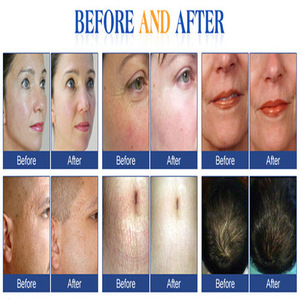 Hot Sale 540 Needles 0.75mm Titanium Needle Skin Care Beauty Derma Roller Rolling System