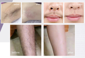 Popular Cosmetic machine 3 wavelength diode laser hair removal