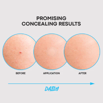 Acne Conceal Pimple Patch 63 Patches(Covers and Protects, Thin, Transparent, Waterproof )