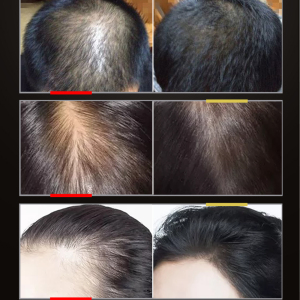 Custom Natural Organic Hair Regrowth Oil Hairloss Treatment Serum Moisturizing Scalp Care Haar Loss Hair Growth Essential Oil