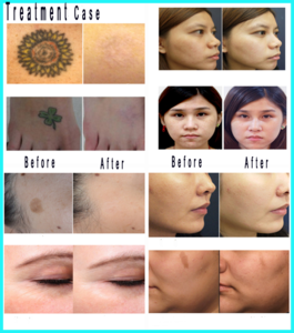 Beauty salon pico laser tattoo medical equipment / laser pico projector/pico laser for tattoo removal