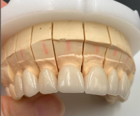 Zirconia Crown Zirconia Teeth Zirconia Denture