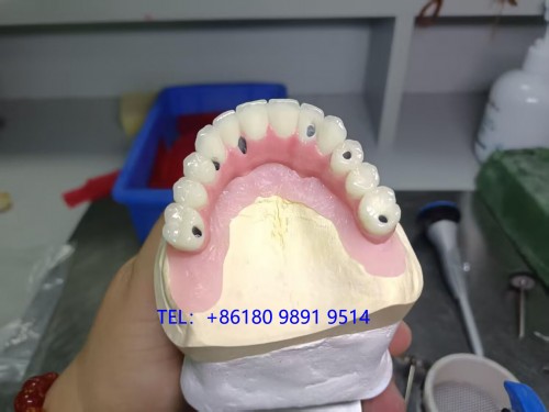Myy Dental Implant Lab from China Zirconia Bridge China Dental Lab