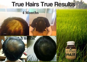 Cornex Hair Regrowth Product