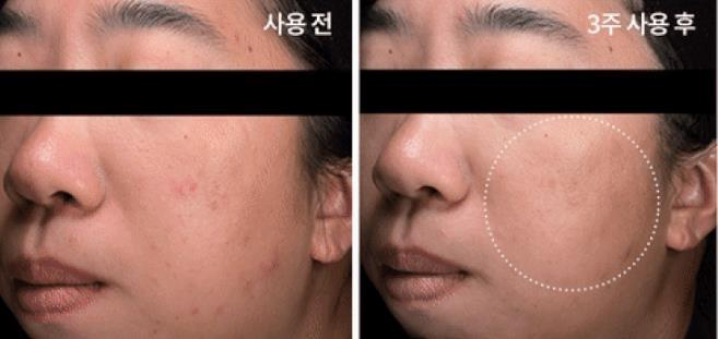 Galvanic Waterpeeling Machine - skin care device