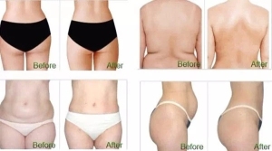 sagging skin treatment remove belly fat beauty salon ISO13485 approval supplier no trauma slimming face care equipment