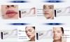 Hyaluronic Acid dermal filler for face