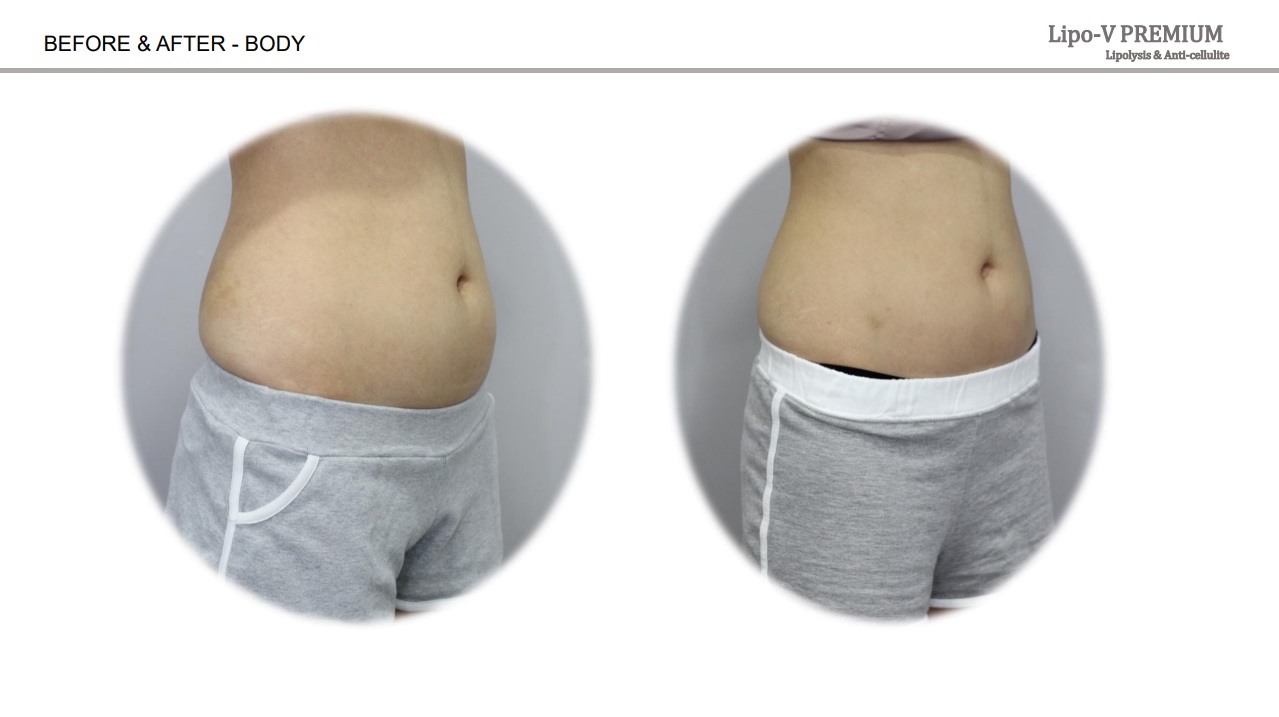 Lipo-V-Premium  (Plant-based, painless lipolytics)