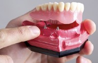 Dental Pfm Crown From China Dental Lab