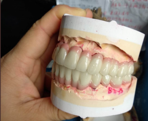 Dental Pfm Crown From China Dental Lab