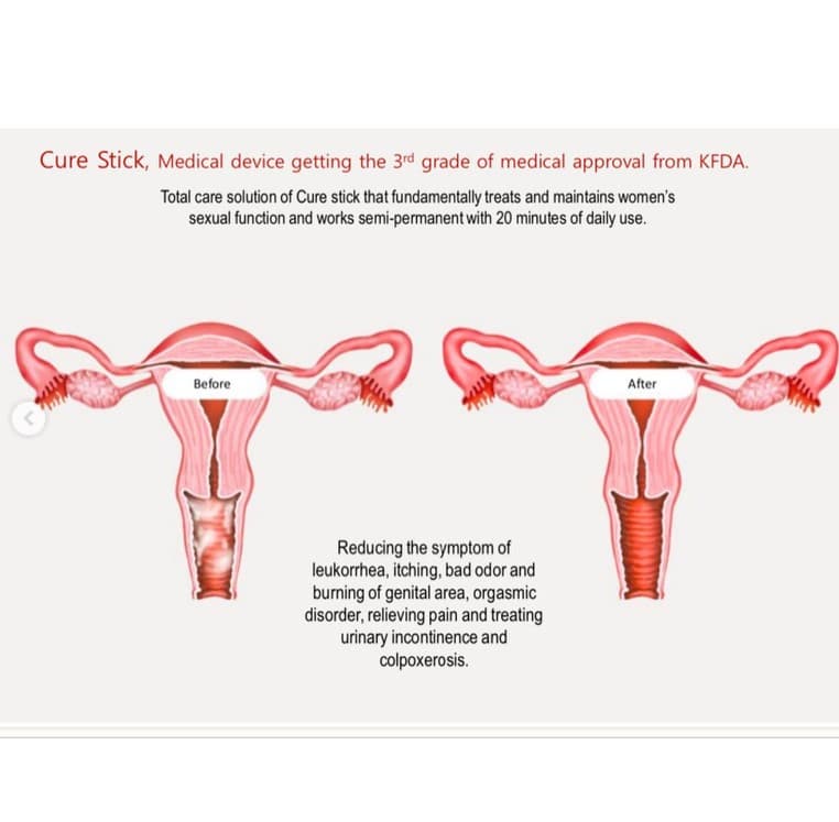 CURE STICK LED FEMALE HEALTH CARE