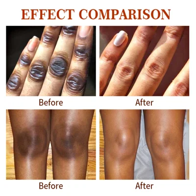 Mooyam Rapid Get Rid of Dark Hand Knuckle Whitening Serum Removing Dark Elbow Knees Clear Dark Knuckles Serum