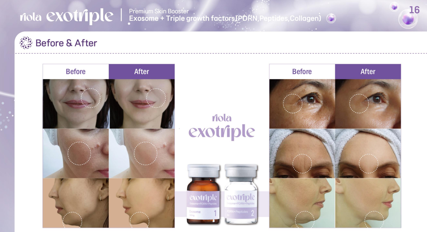 Riola Exotriple CICA Exosome, PDRN, Collagen Premium Skin Rejuvenation (Mini Set)