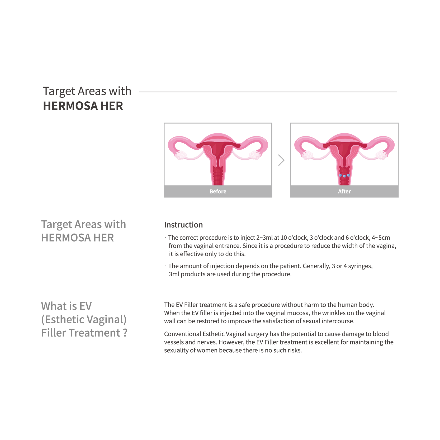 HERMOSA Dermal Filler_HER (Body filler for women) 3.0 ml * 1 syringe / pack