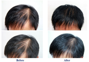 Minoxidil Hair Growth Spray effective Anti Hair Loss spray Stop Hair Loss,new  hair grow,Hair Treatment for Men & Women - Guangzhou Ideal Cosmetic Co.,  Ltd. | BeauteTrade