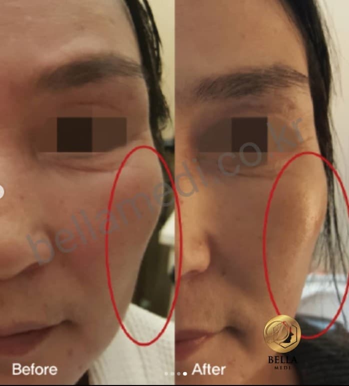 SOSUM PCL COLLAGEN SOLUTION