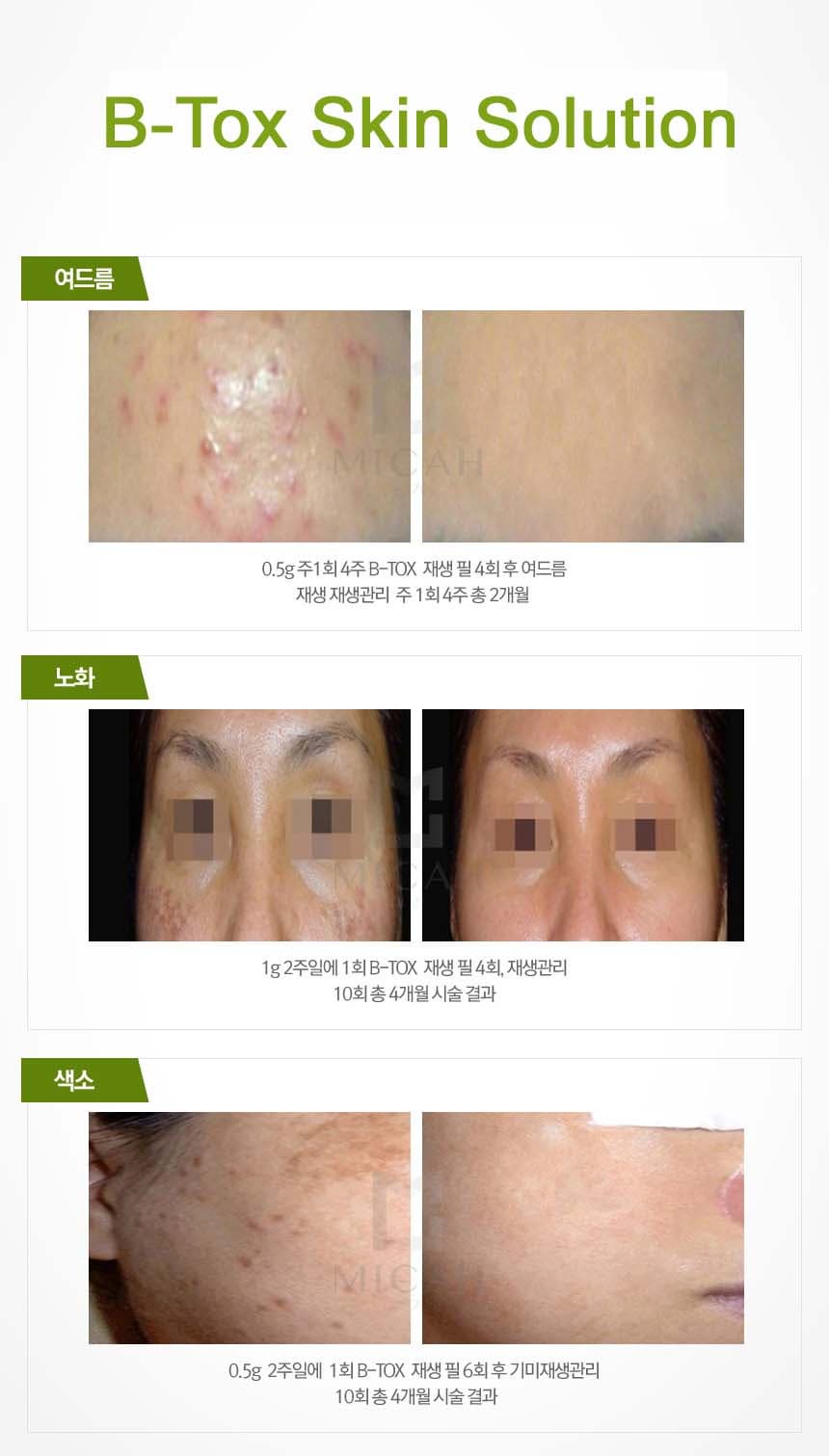 B-Tox Peel Skin Renewal Solution