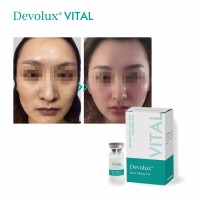 Devolux Vital cosmetic fillers poly l lactic acid skin care products plla filler Liquid