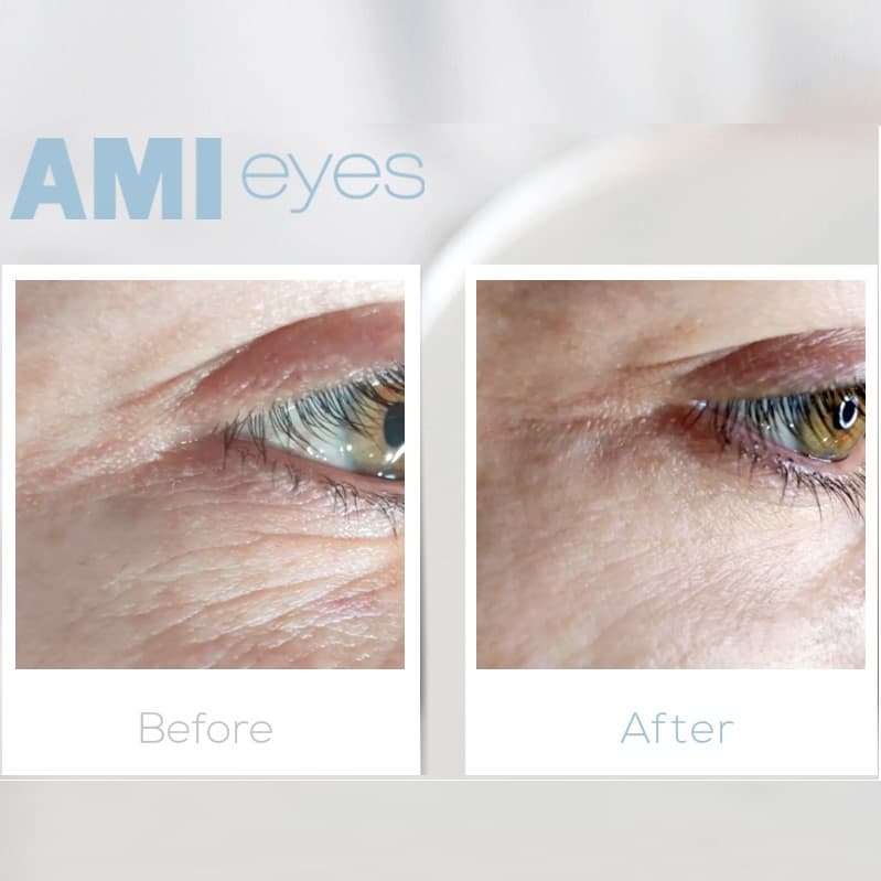 AMI eyes, Skin Booster, PN Injection, AMI eyes Filler , amieyes , amieyes skinbooster, darkeyes