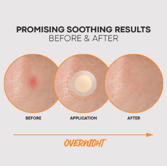 Brightening Microneedle Patch 12 Patches Red Spot Care from Acne Pimple Blemish - Overnight