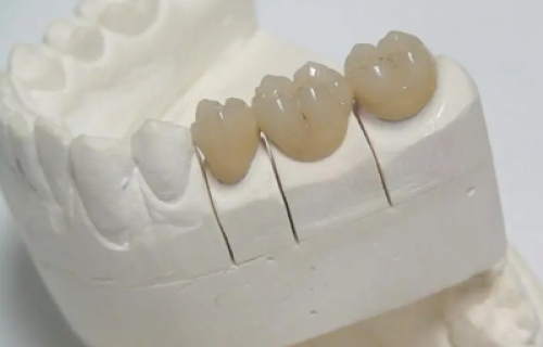 CROWN & BRIDGES | ALL CERAMICS Zirconia Solid