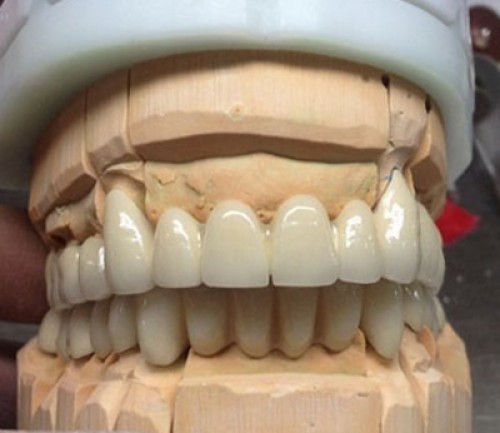 CROWN & BRIDGES | ALL CERAMICS Zirconia Solid