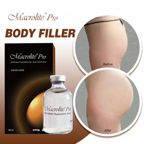 Wholesale 50ml Hyaluronic Acid Filler Buttock Lift Injection Price for Bigger Breast