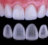 CROWN & BRIDGES | ALL CERAMICS Zirconia Solid