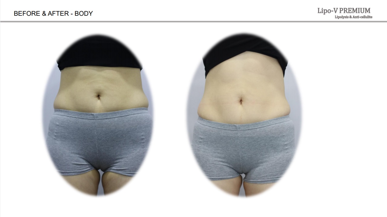 Lipo-V-Premium  (Plant-based, painless lipolytics)