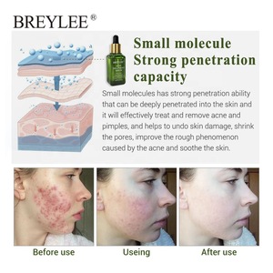 NEW arrival BREYLEE brand skin care removal acne scar acne treatment serum