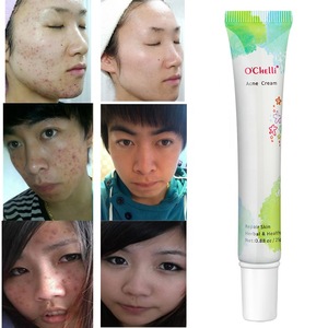 OEM/ODM 25g Ochelli Best Pimples Removal Face  Anti Acne Cream