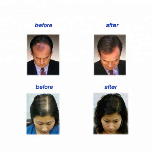Private Label  hair care product Yuda hair loss treatment hair growth spray