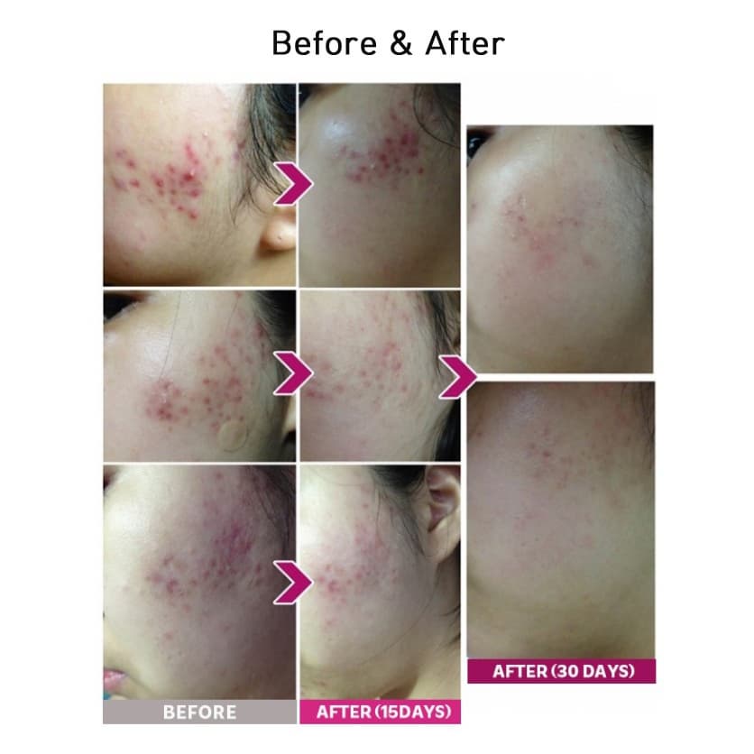 Blemish Care Up Serum