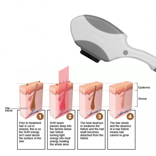 2022 Hair Removal Machine Diode Laser Hair Removal 755 808 1064 for Hair Removal Laser Machine