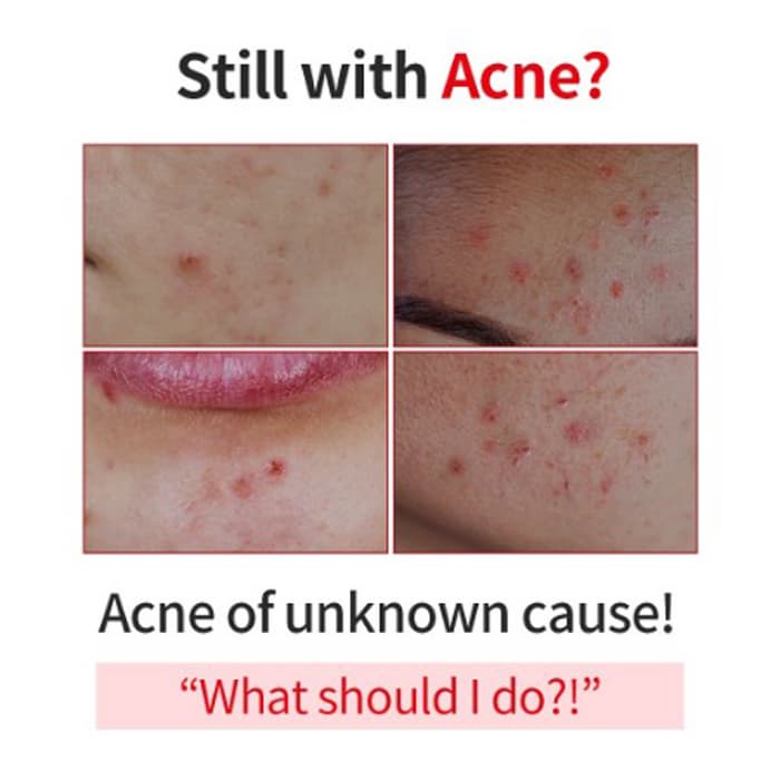 Anti-Acne Cream