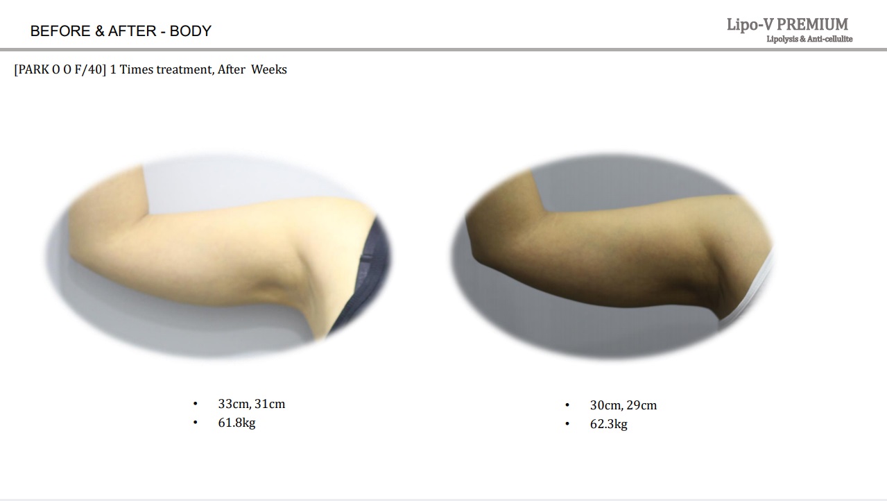 Lipo-V-Premium  (Plant-based, painless lipolytics)