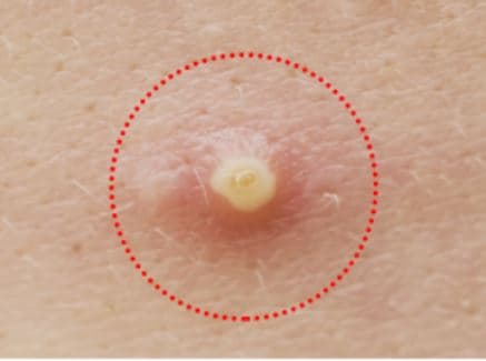 Korean Favorite like Acne Pimple Master Patch