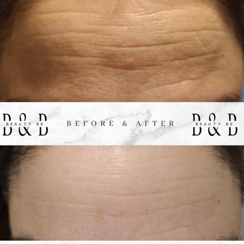 Beautybe Botox Cream with Instant Effect