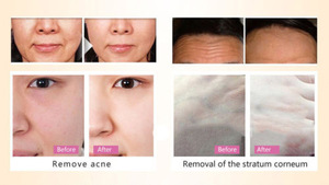 2019 best seller portable Anion facial skin cleaner ultrasonic skin scrubber