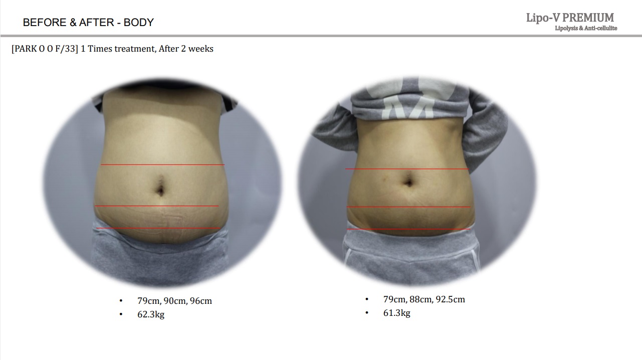 Lipo-V-Premium  (Plant-based, painless lipolytics)