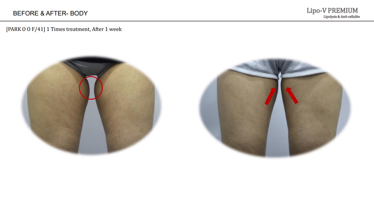Lipo-V-Premium  (Plant-based, painless lipolytics)