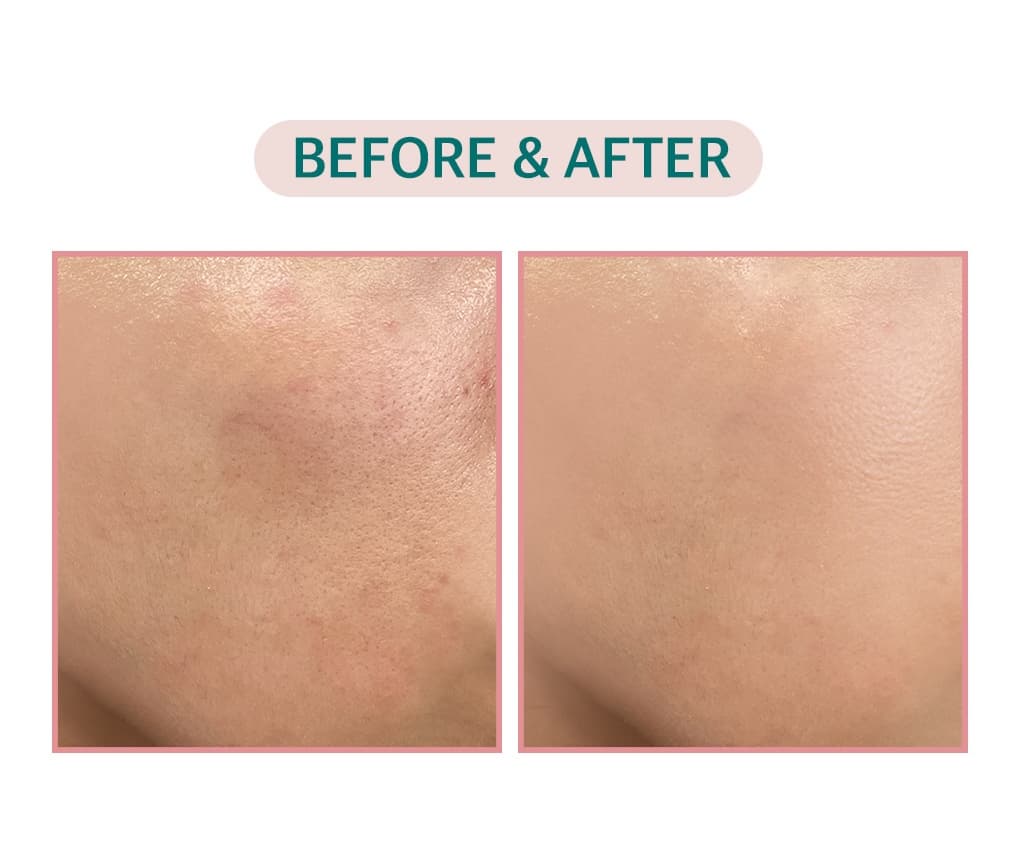 VEGAN Skin Care Tea Tree Cica 80 Toner – Soothing &amp; Sebum Balancing