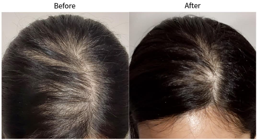 Elastic Lab H, hair loss, alopecia, scalp care, hair booster 