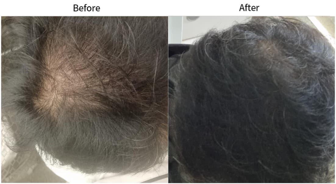 Elastic Lab H, hair loss, alopecia, scalp care, hair booster 