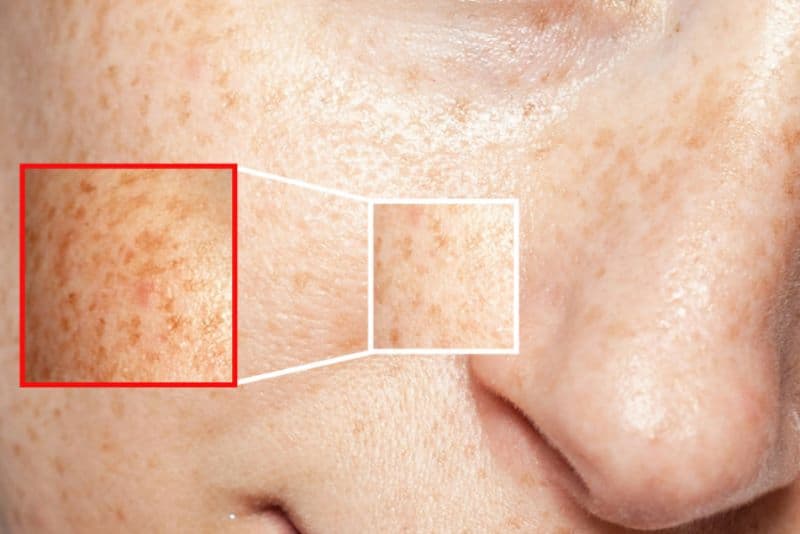 Vitamin freckle Cream