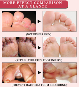 Foot Cream Herbal Anti Fungal Relieve Beriberi Cream Foot Care Treatment Skin Care Anti Fungal Infection Foot Repair Cream